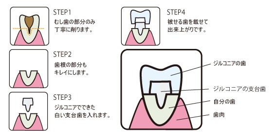ジルコニア