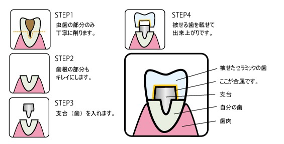 メタルボンド