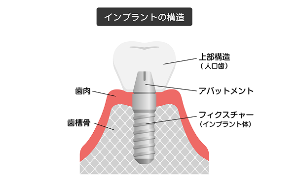 implant_image01