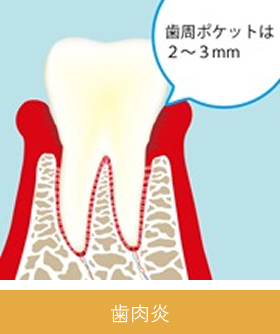 periodontal_image03
