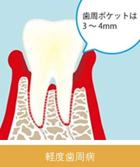 periodontal_image04