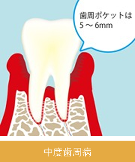 periodontal_image05